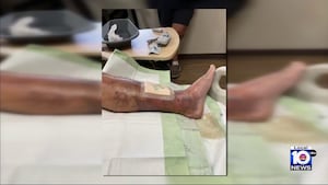Experts warn against dangerous flesh-eating bacteria in Florida