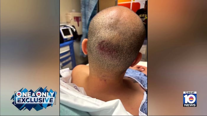 ‘He deserves to be in jail': Suspect charged, victim recovering after Aventura softball bat attack