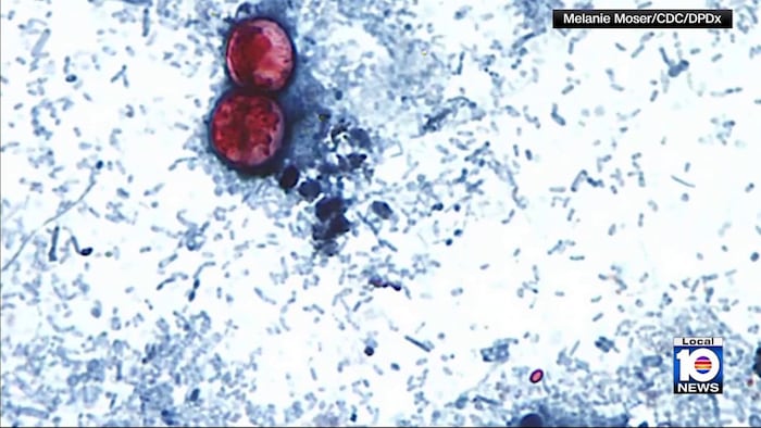 Florida reports several Cyclospora cases as seasonal intestinal illness returns