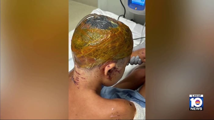 Mother of 9-year-old boy mauled by dogs in Bimini gives update on his recovery